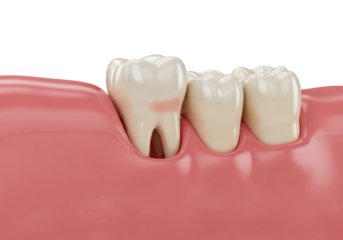 Isolated Impacted Wisdom Tooth in Gum 3D Render