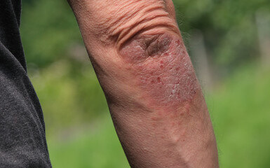 Psoriasis Schuppenflechte Hautkrankheit an Ellenbogen, schuppige entzündende juckende Haut....