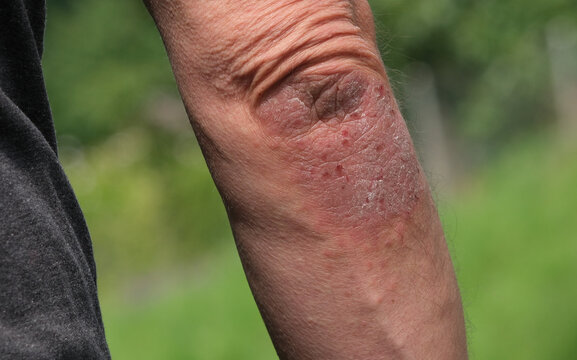 Psoriasis Schuppenflechte Hautkrankheit an Ellenbogen, schuppige entz&uuml;ndende juckende Haut. entz&uuml;ndete Haut an Gelenken