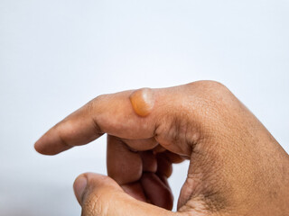 bubbles due to second degree burns on the fingers
