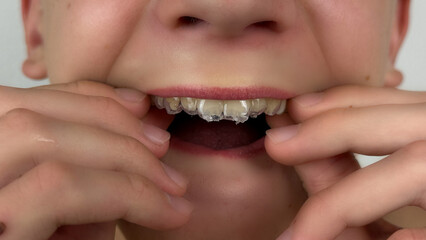 Teenage boy putting on transparent dental mouthguard for bruxism, close-up of orthodontic aligner...