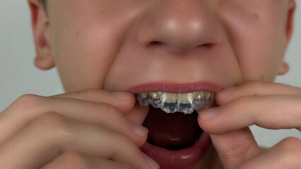 Teenage boy putting on transparent dental mouthguard for bruxism, close-up of orthodontic aligner...