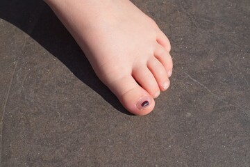 Foot with hematoma under the nail of the big toe.