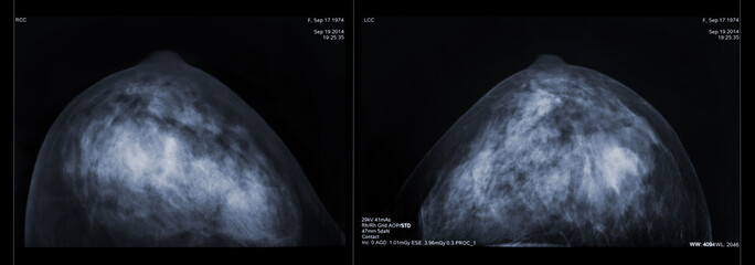 Mammogram both breast, cc view, breast scan. X-ray mammogram or mammography image for screening...