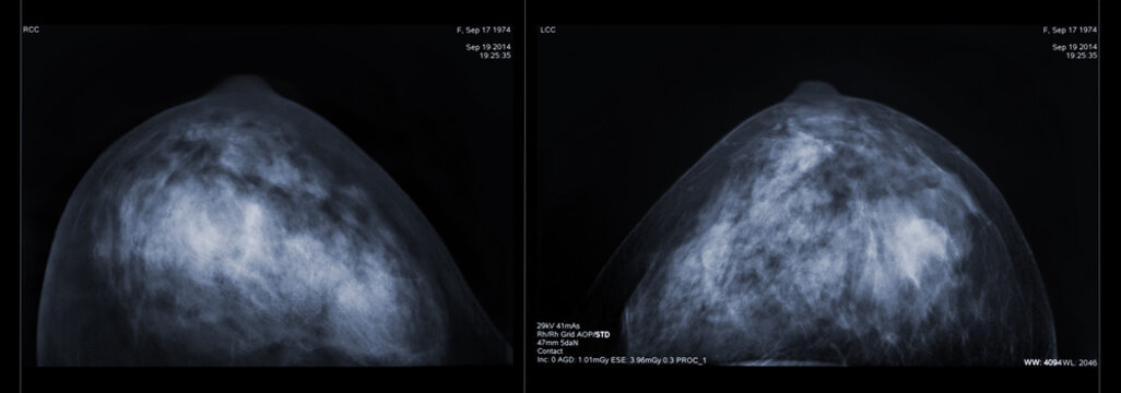 Mammogram both breast, cc view, breast scan. X-ray mammogram or mammography image for screening breast cancer. 