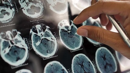 Doctor's hand using pen to pointing at brain x-rays on digital tablet. Doctor analyzing CT or MRI Brain Scan Images. Brain X-ray image on Digital Tablet. - Powered by Adobe