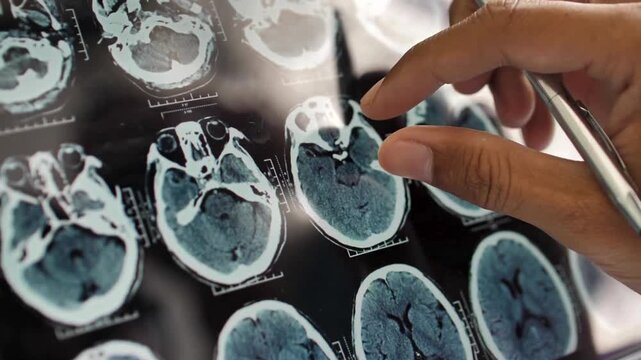 Doctor's hand using pen to pointing at brain x-rays on digital tablet. Doctor analyzing CT or MRI Brain Scan Images. Brain X-ray image on Digital Tablet. - Powered by Adobe