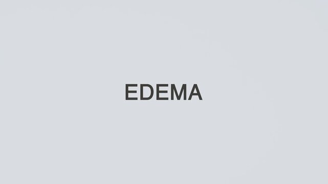 Edema word diagnosed with a stethoscope held in hand on a white background, illustrating fluid retention, medical evaluation, healthcare concept, and patient awareness