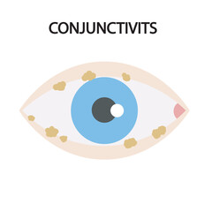 Medical vector of conjunctivitis showing red, itchy, watery eyes with swelling. Highlights symptoms and distinguishes from allergies, dry eye, and blepharitis.