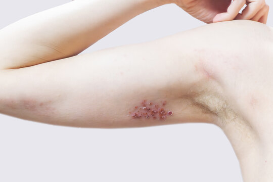Woman with shingles on the skin she feels very painful. High quality photo