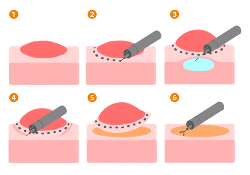 内視鏡的粘膜下層剥離術　ESD　	
