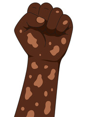 Fist pose vitiligo people. Unique skin pigmentation highlighting natural beauty. World vitiligo day. Skin depigmentation, skin disorder, self acceptance, emotional support.