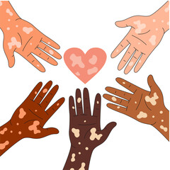 Set hand people with vitiligo and love. Vitiligo people with different skin colors putting hands together. World vitiligo day. Skin depigmentation, skin disorder, self acceptance.