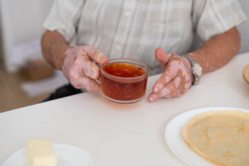 Vitiligo on the hands of an elderly man. Close-up of a man's hands holding a cup of tea. Autoimmune disease