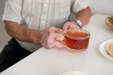 Vitiligo on the hands of an elderly man. Close-up of a man's hands holding a cup of tea. Autoimmune disease