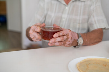 Vitiligo on the hands of an elderly man. Close-up of a man's hands holding a cup of tea. Autoimmune disease