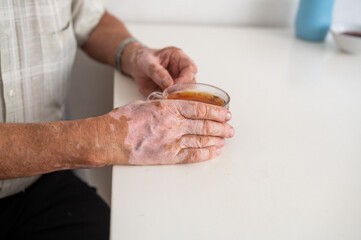 Vitiligo on the hands of an elderly man. Close-up of a man's hands holding a cup of tea. Autoimmune...