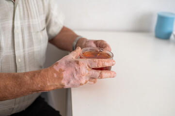 Vitiligo on the hands of an elderly man. Close-up of a man's hands holding a cup of tea. Autoimmune...