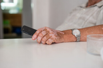 The hands of an elderly man with vitiligo. An autoimmune disease