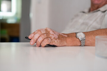The hands of an elderly man with vitiligo. An autoimmune disease