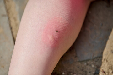 red, swollen mosquito bite on leg under natural light. Rough stone background enhances focus on...