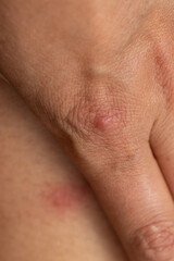 A hand with a red mark on it