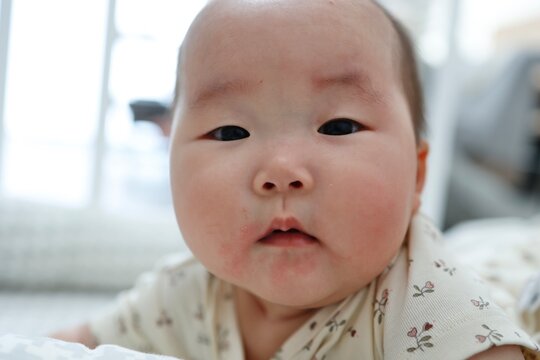 よだれかぶれで口周りが赤くなった5ヶ月の女の子の赤ちゃん
