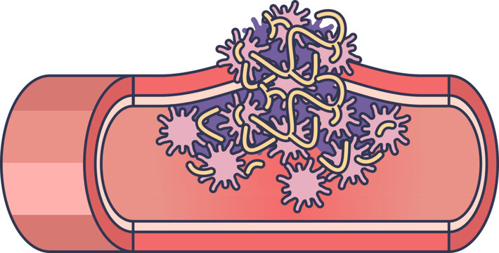 Medical illustration of clot overgrowth in a blood vessel. A thrombus, formed by platelets and fibrin, obstructs blood flow, representing thrombosis.