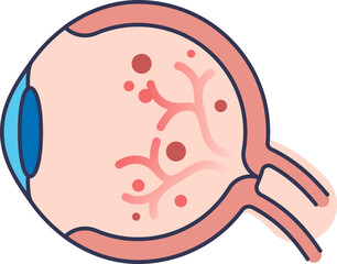 A medical illustration of an eye with diabetic retinopathy. Shows a cross-section of the eyeball with damaged blood vessels and hemorrhages on the retina, a complication of diabetes.