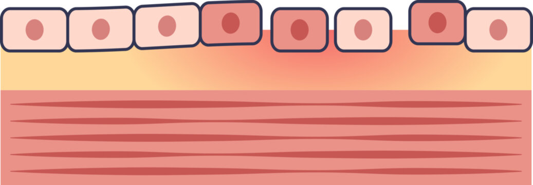 Medical diagram of endothelial injury. The damaged inner lining of a blood vessel shows disrupted endothelial cells, a key factor in cardiovascular disease and atherosclerosis.