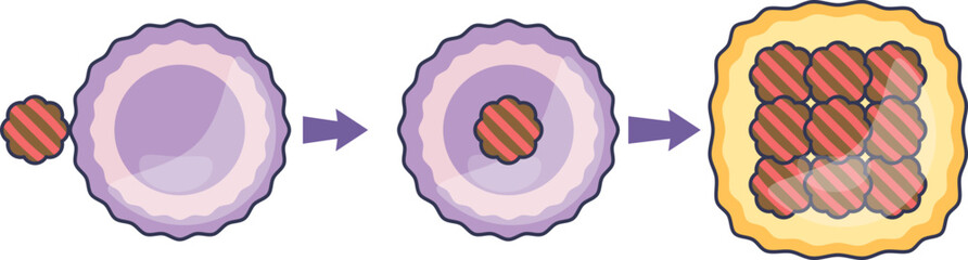 Diagram of macrophage foam cell formation. A macrophage engulfs lipids (LDL), accumulating them to become a foam cell, a key step in atherosclerosis and plaque development.