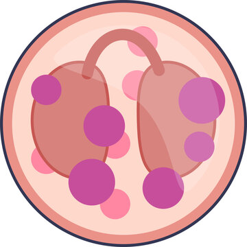 A vector illustration of a mature eosinophil, a type of granulocyte. It shows the characteristic bilobed nucleus and large eosinophilic granules within the cytoplasm. Represents immune response.