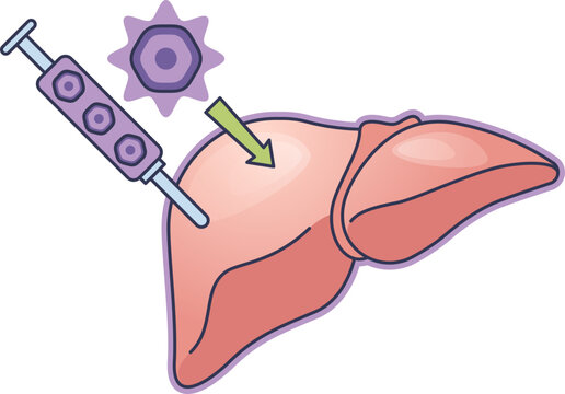 Illustration of pancreatic islet cell transplantation. A syringe injects islet cells into the liver, a procedure to treat type 1 diabetes by restoring insulin production.