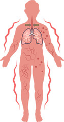 Obraz na płótnie Canvas Medical illustration of systemic anaphylaxis symptoms. Shows a human figure with skin rash, hives, and respiratory distress, indicating a severe, body-wide allergic reaction and anaphylactic shock.