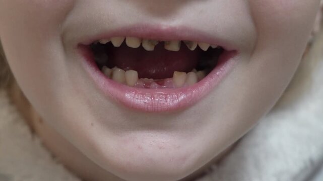 a child without a tooth, milk teeth fell out and caries on the teeth of a little girl
