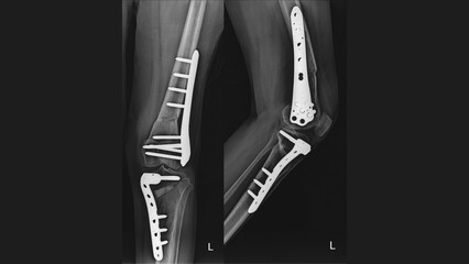 Left Leg X-Ray: Postoperative Views Showing Internal Fixation with Plates and Screws