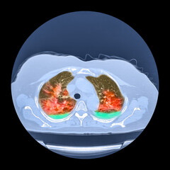 Lungs affected by Covid-19 pneumonia, CT scan