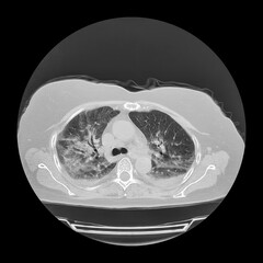 Lungs affected by Covid-19 pneumonia, CT scan