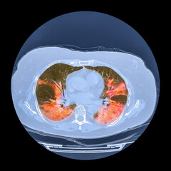 Lungs affected by Covid-19 pneumonia, CT scan