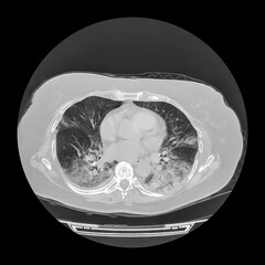 Lungs affected by Covid-19 pneumonia, CT scan