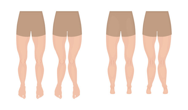 Genu valgum, genu varum and normal legs, front and back view comparison