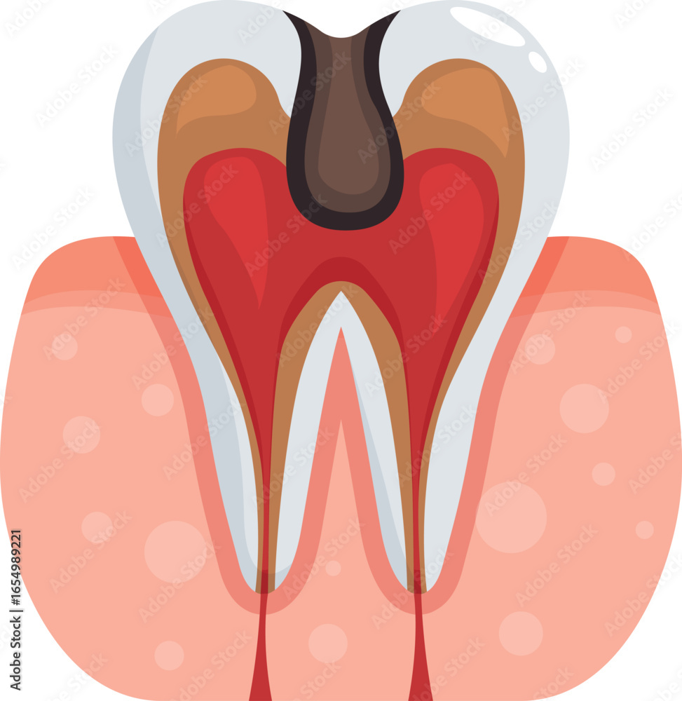 Poster cross section of molar showing advanced tooth decay affecting pulp and causing inflammation in surro