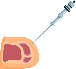 Steroid injection being administered into a knee joint, providing pain relief and reducing inflammation