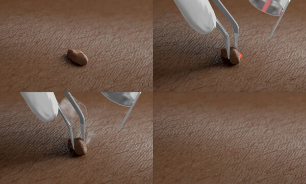 Skin surface with papilloma laser removal treatment process macro