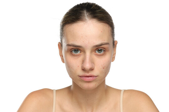 Young woman with acne and bare skin looking at camera, skincare concept, studio shot on white background