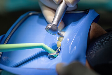 Close-up of root canal treatment with a high-speed dental handpiece under rubber dam isolation....