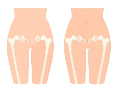 Side-by-side female anatomy diagrams showing different hip/thigh shapes