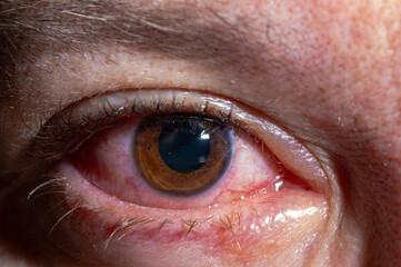 Red inflamed eyes of a man, vessels in the eyes are visible, detachment of the film of the eye. Eye problems, infection, drug exposure, alcohol intoxication.