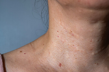 Fototapeta premium Woman's skin after subcutaneous injections to smooth out wrinkles.