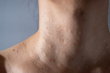 Naklejka premium Woman's skin after subcutaneous injections to smooth out wrinkles.